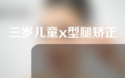 三岁儿童x型腿矫正