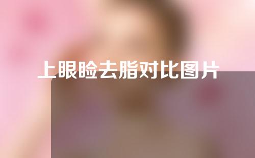 上眼睑去脂对比图片