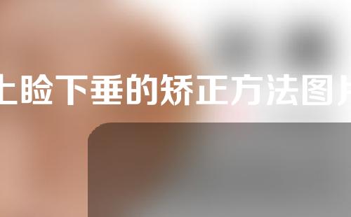 上睑下垂的矫正方法图片