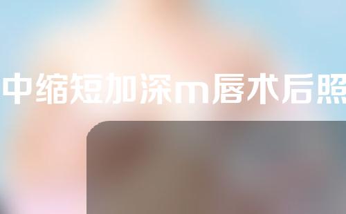 人中缩短加深m唇术后照片