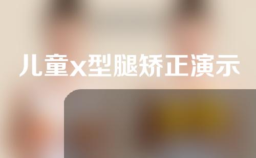 儿童x型腿矫正演示