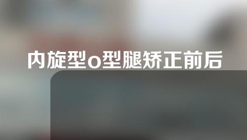内旋型o型腿矫正前后