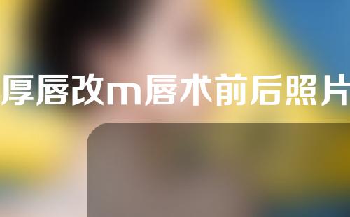 厚唇改m唇术前后照片