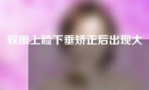 双眼上睑下垂矫正后出现大小眼