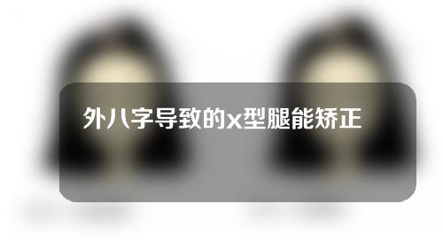 外八字导致的x型腿能矫正吗