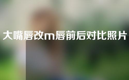大嘴唇改m唇前后对比照片