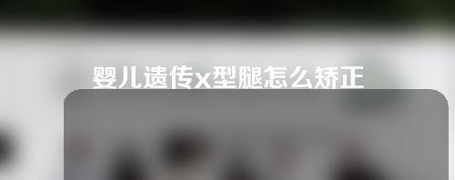 婴儿遗传x型腿怎么矫正