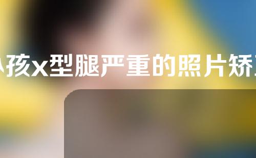 小孩x型腿严重的照片矫正