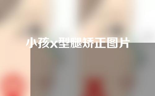 小孩x型腿矫正图片