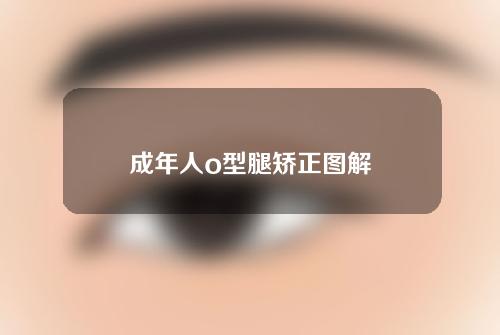 成年人o型腿矫正图解