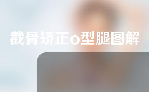 截骨矫正o型腿图解