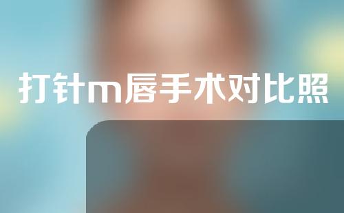 打针m唇手术对比照