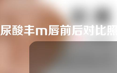 玻尿酸丰m唇前后对比照片
