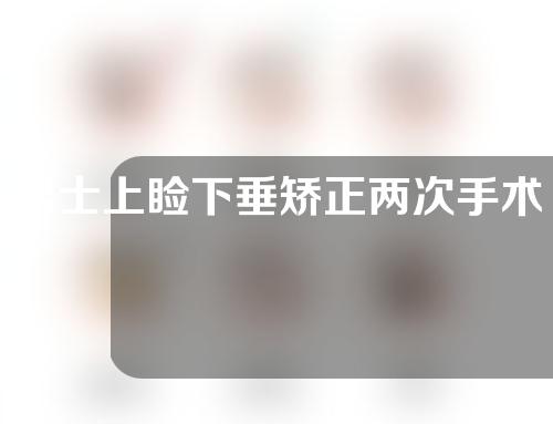 男士上睑下垂矫正两次手术