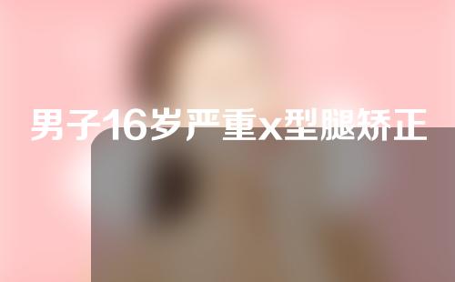 男子16岁严重x型腿矫正