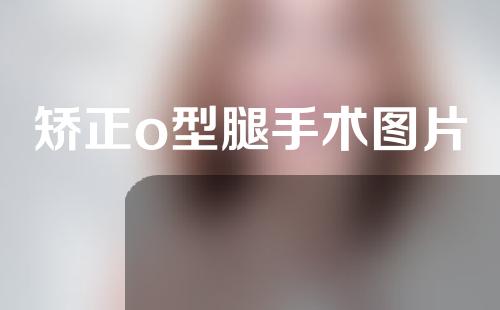 矫正o型腿手术图片