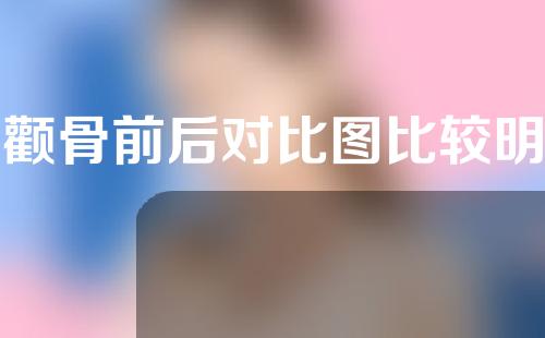 磨颧骨前后对比图比较明显磨颧骨的优势有什么？