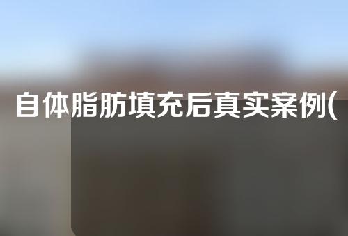 自体脂肪填充后真实案例(自体脂肪填充成功案例)
