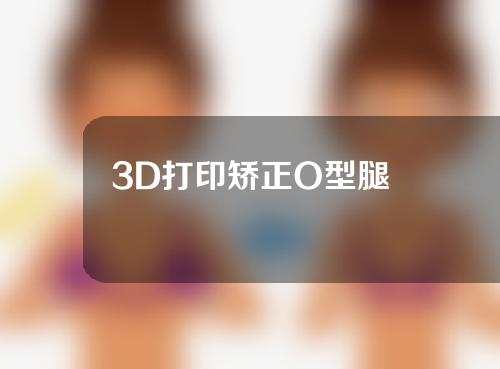 3D打印矫正O型腿