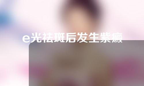 e光祛斑后发生紫癜