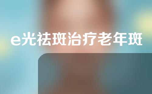 e光祛斑治疗老年斑