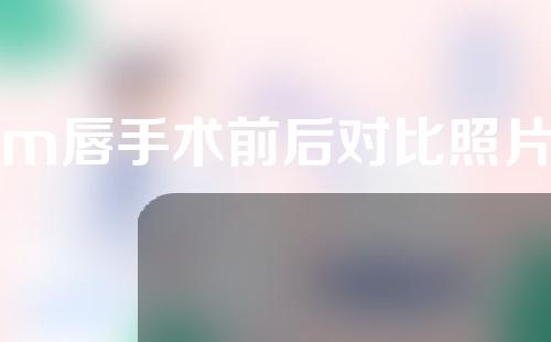 m唇手术前后对比照片