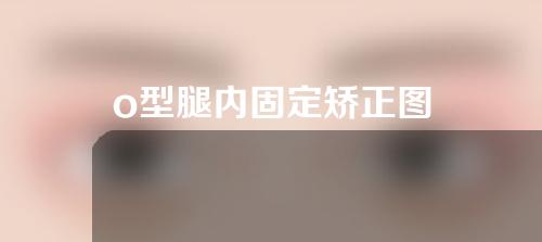 o型腿内固定矫正图