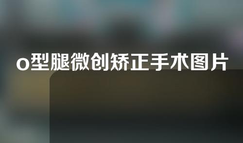 o型腿微创矫正手术图片