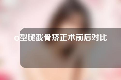 o型腿截骨矫正术前后对比