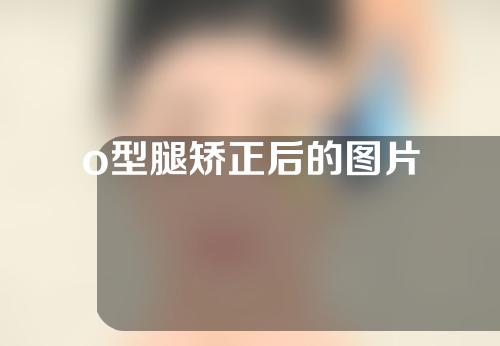 o型腿矫正后的图片