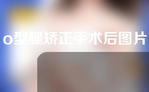o型腿矫正手术后图片
