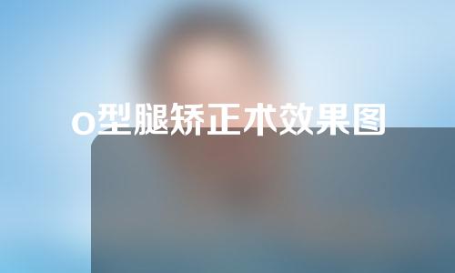 o型腿矫正术效果图