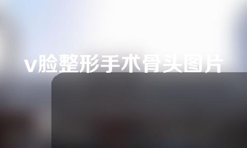 v脸整形手术骨头图片