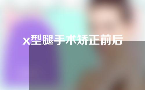 x型腿手术矫正前后