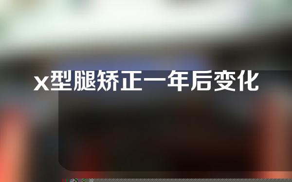 x型腿矫正一年后变化