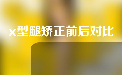 x型腿矫正前后对比