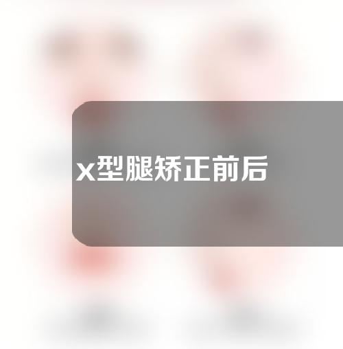 x型腿矫正前后