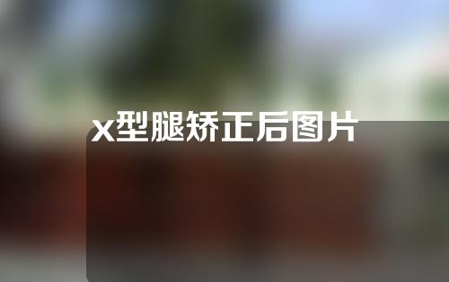 x型腿矫正后图片